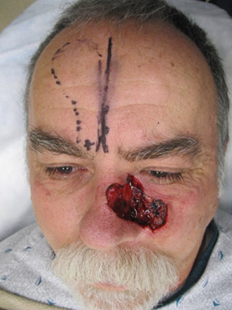 Complex Facial Reconstruction after Cancer and Trauma Before & After Gallery - Patient 174164401 - Image 1