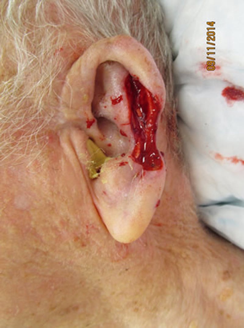 Complex Facial Reconstruction after Cancer and Trauma Before & After Gallery - Patient 174164407 - Image 1