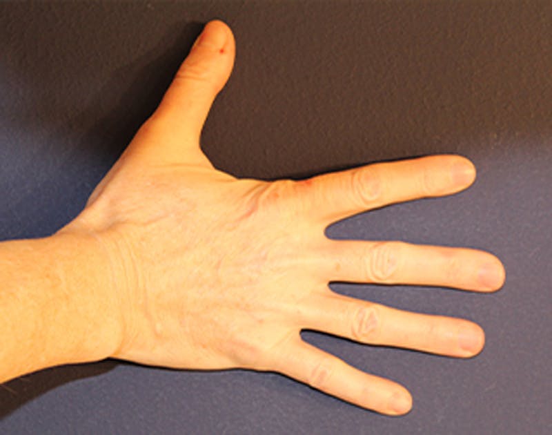 Hand Rejuvenation Before & After Gallery - Patient 174163305 - Image 1