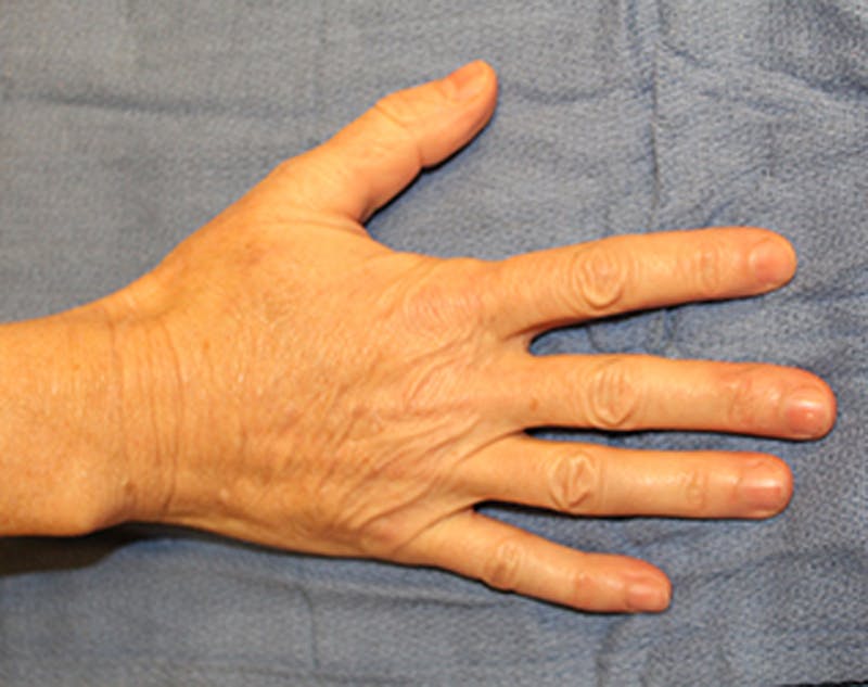 Hand Rejuvenation Before & After Gallery - Patient 174163305 - Image 2