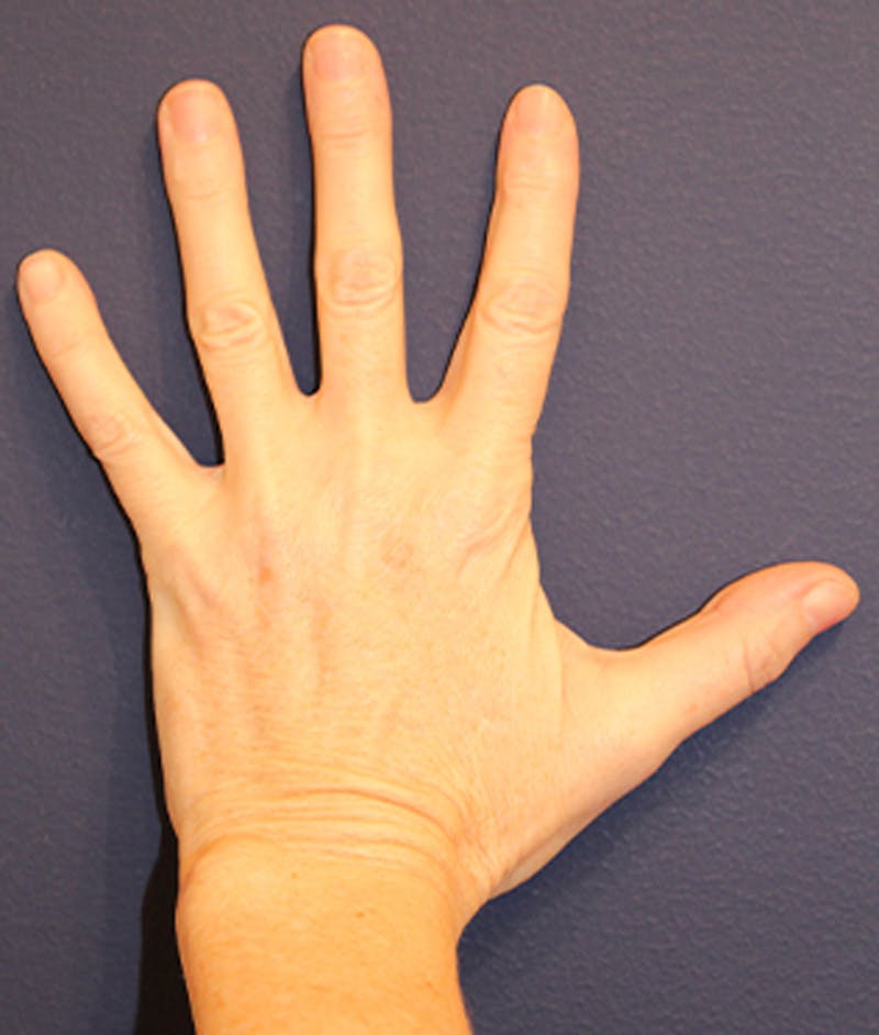 Hand Rejuvenation Before & After Gallery - Patient 174163305 - Image 3