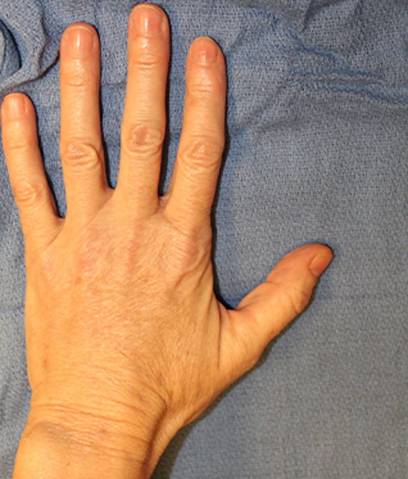Hand Rejuvenation Before & After Gallery - Patient 174163305 - Image 4