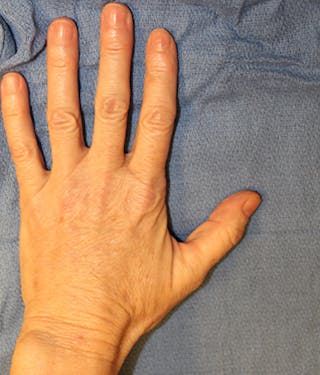 Hand Rejuvenation Before & After Gallery - Patient 174163305 - Image 4