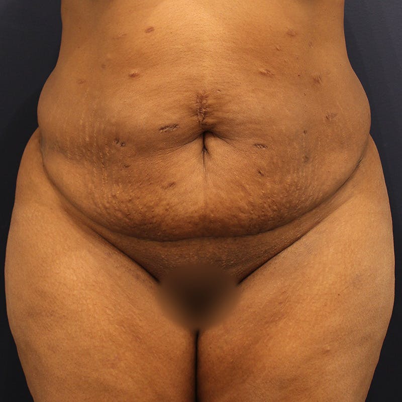 Tummy Tuck Before & After Gallery - Patient 190629196 - Image 1