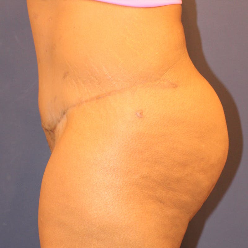 Tummy Tuck Before & After Gallery - Patient 190629196 - Image 4