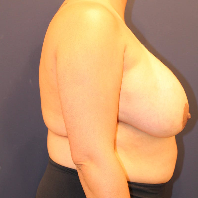 Breast Lift with Augmentation Before & After Gallery - Patient 190629219 - Image 6