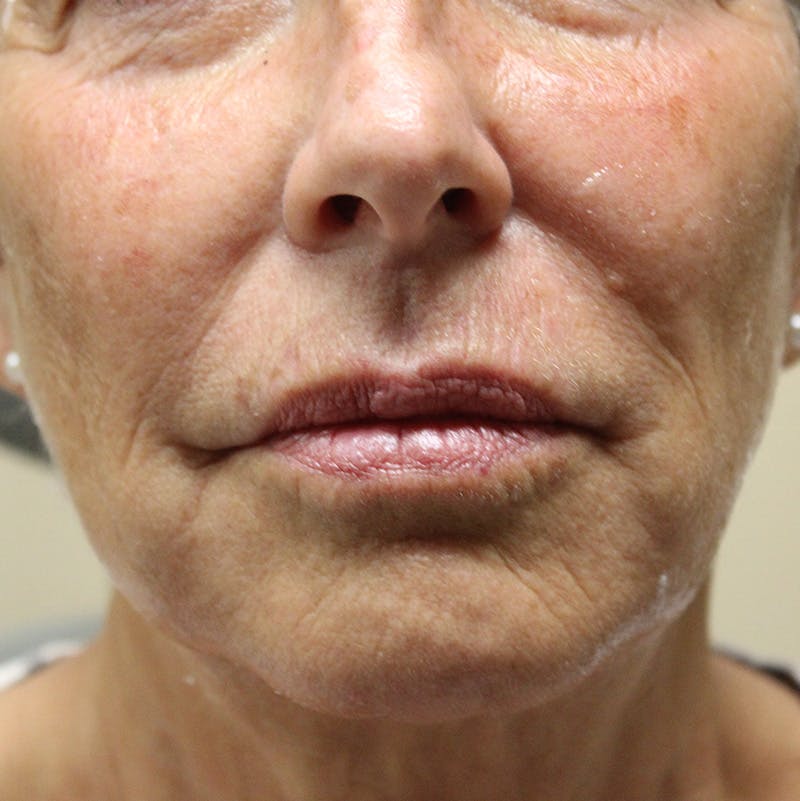 Injectables Before & After Gallery - Patient 190629222 - Image 1