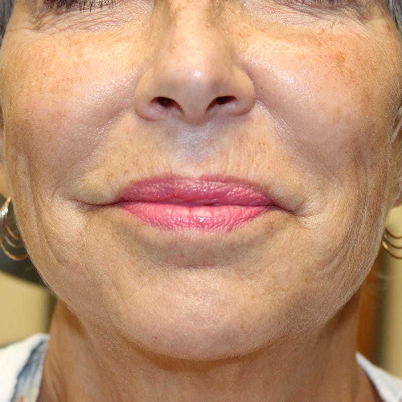 Injectables Before & After Gallery - Patient 190629222 - Image 2