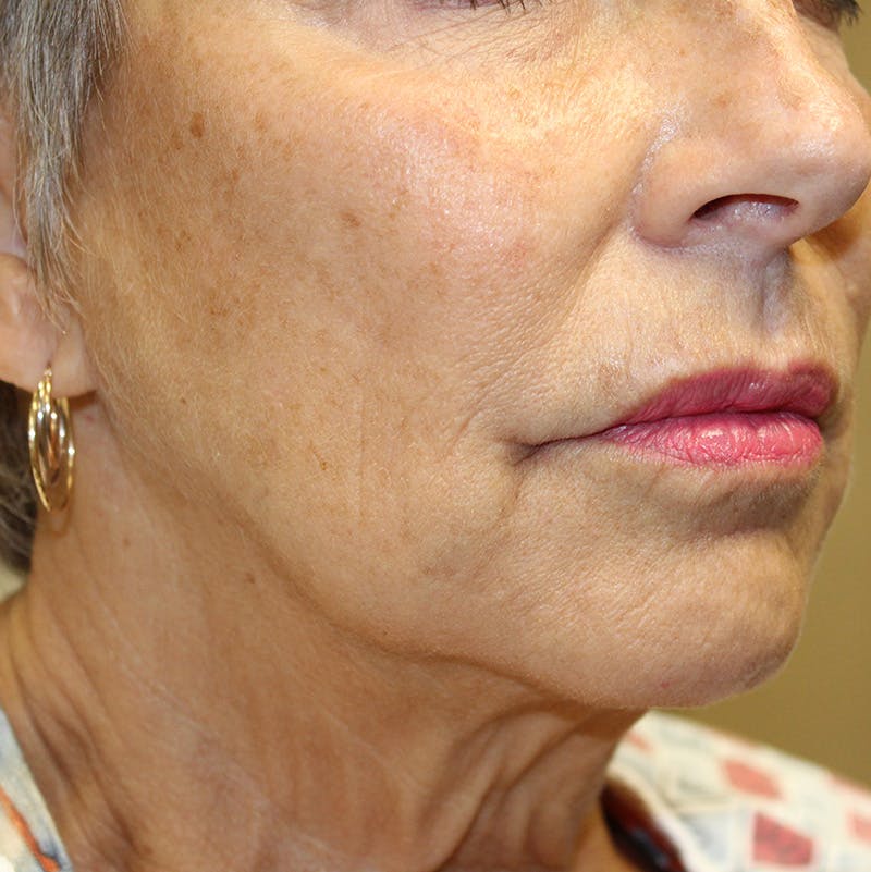 Injectables Before & After Gallery - Patient 190629222 - Image 4
