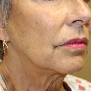 Injectables Before & After Gallery - Patient 190629222 - Image 4
