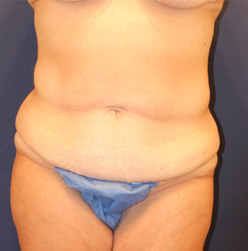 Tummy Tuck Before & After Gallery - Patient 192265697 - Image 1