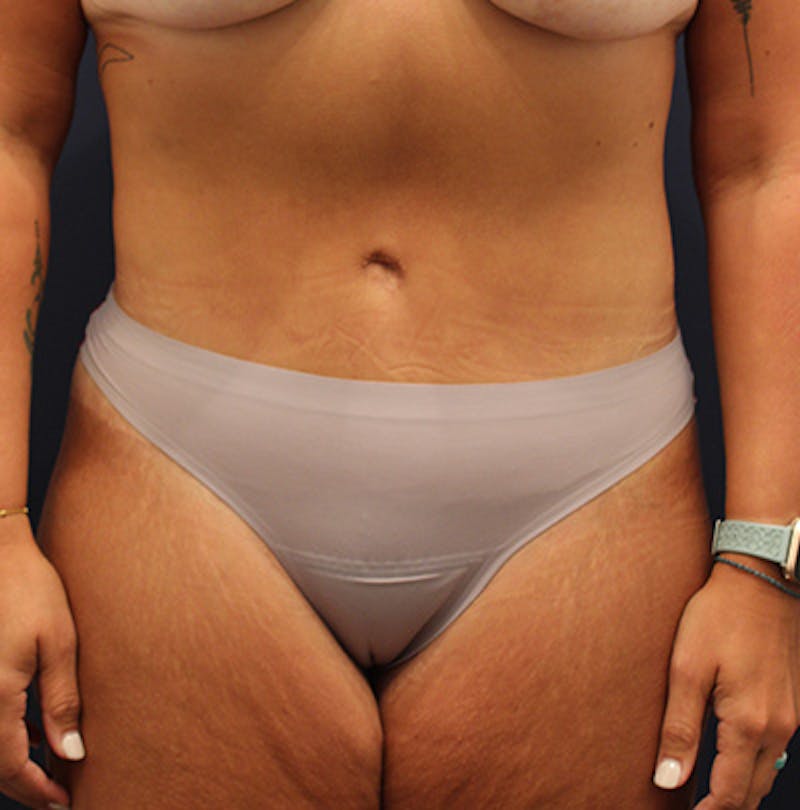 Tummy Tuck Before & After Gallery - Patient 192265697 - Image 2