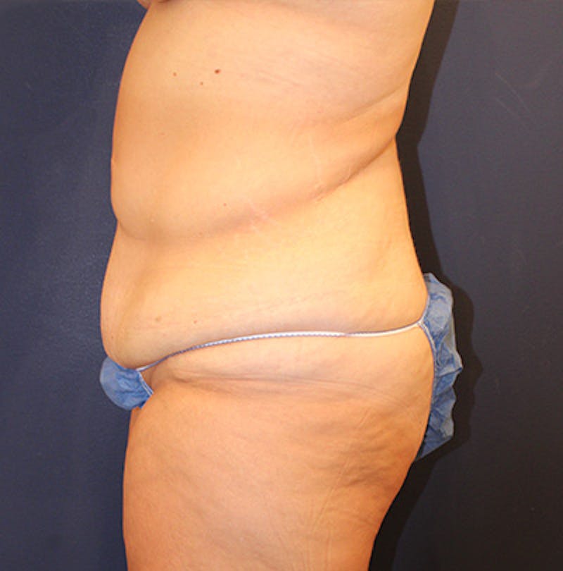 Massive Weight Loss Before & After Gallery - Patient 192265672 - Image 3