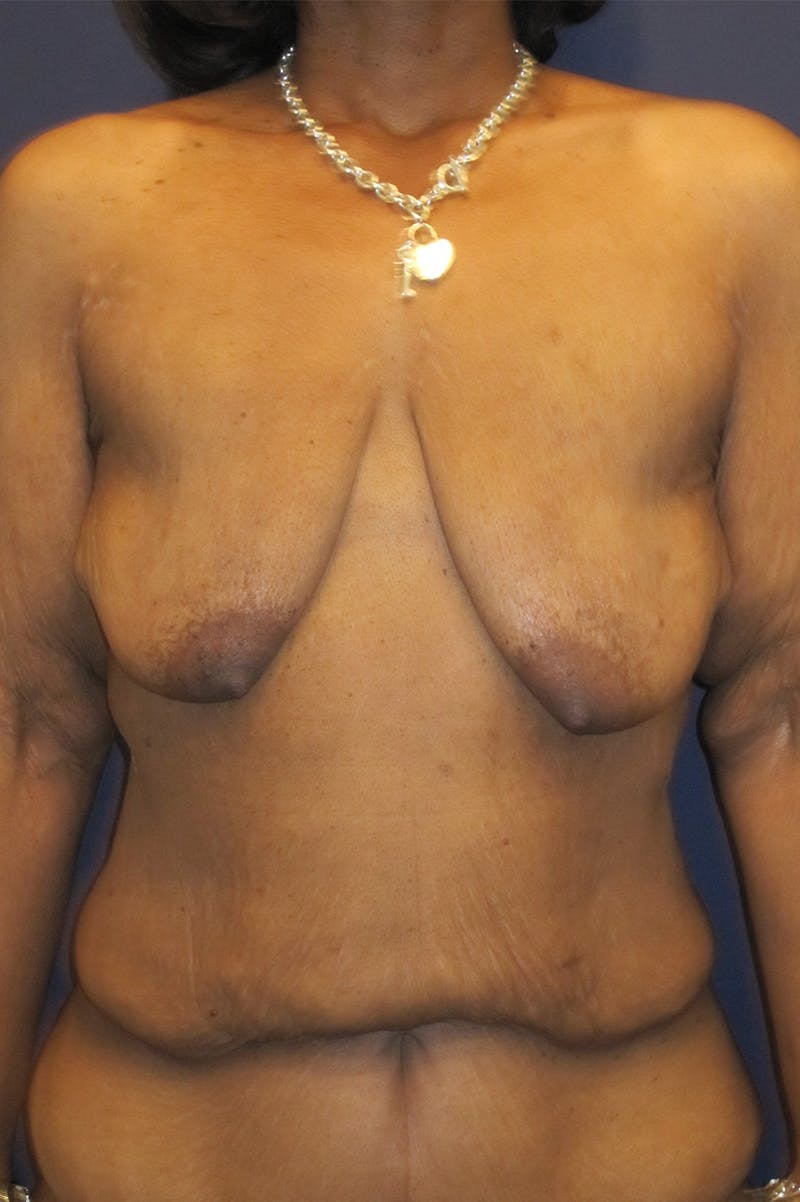 Massive Weight Loss Before & After Gallery - Patient 196276784 - Image 1