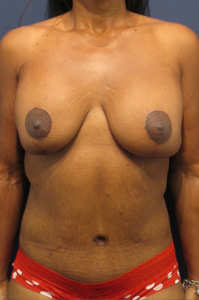 Massive Weight Loss Before & After Gallery - Patient 196276784 - Image 2