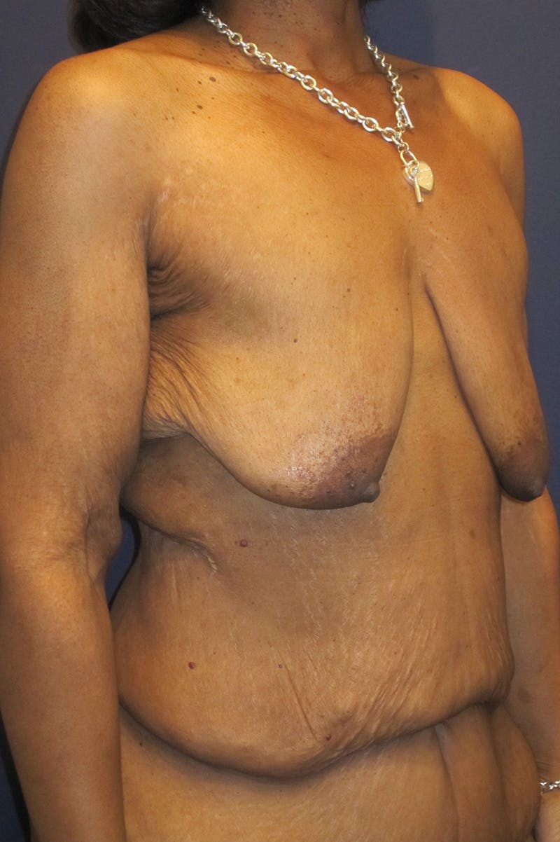 Massive Weight Loss Before & After Gallery - Patient 196276784 - Image 3