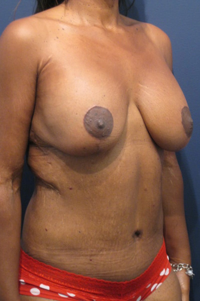 Massive Weight Loss Before & After Gallery - Patient 196276784 - Image 4