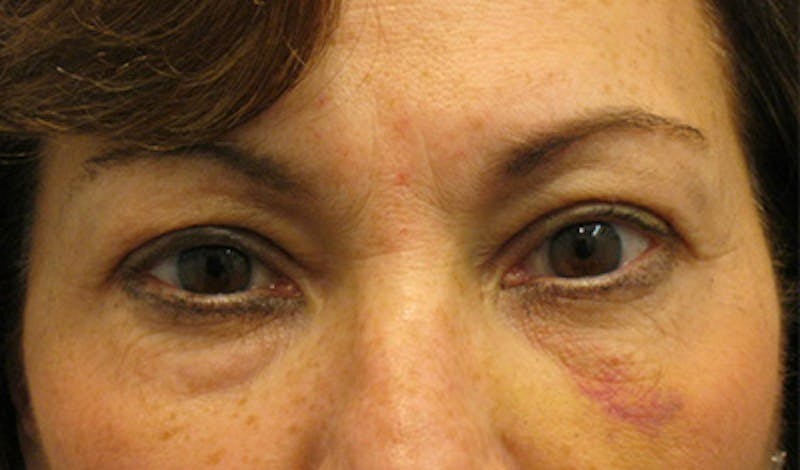 Brow Lift Before & After Gallery - Patient 196276788 - Image 1