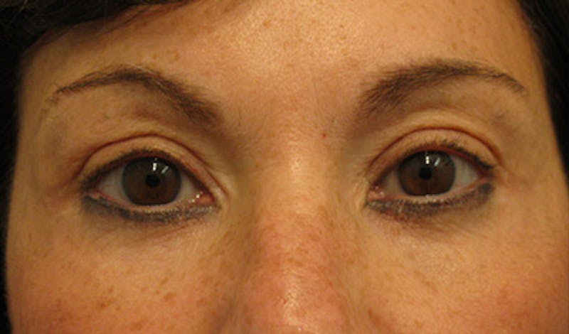 Brow Lift Before & After Gallery - Patient 196276788 - Image 2