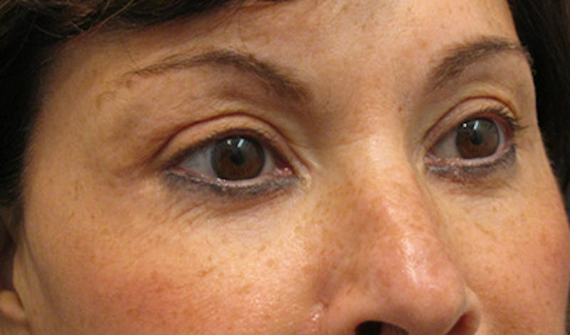 Brow Lift Before & After Gallery - Patient 196276788 - Image 4