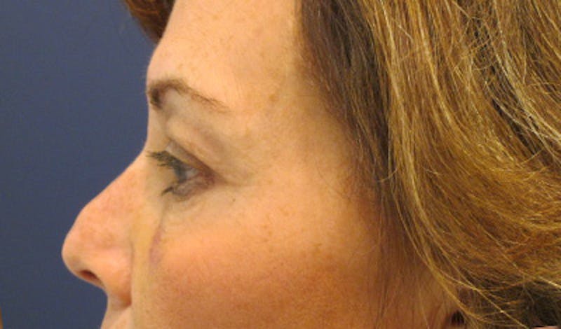 Brow Lift Before & After Gallery - Patient 196276788 - Image 5
