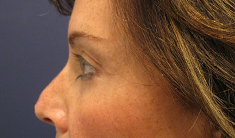 Brow Lift Before & After Gallery - Patient 196276788 - Image 6