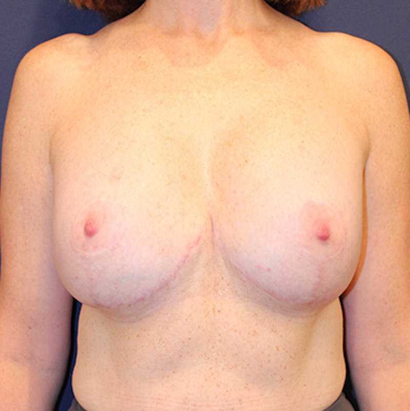 Breast Lift with Augmentation Before & After Gallery - Patient 198283732 - Image 2
