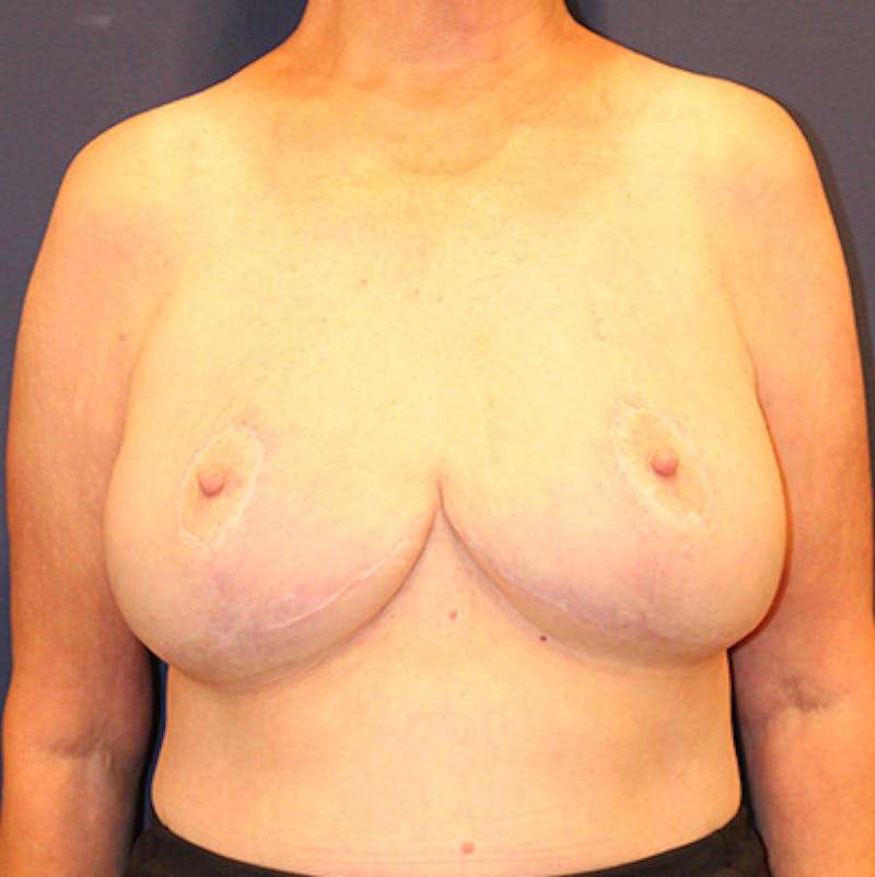 Breast Lift Before & After Gallery - Patient 198283783 - Image 2