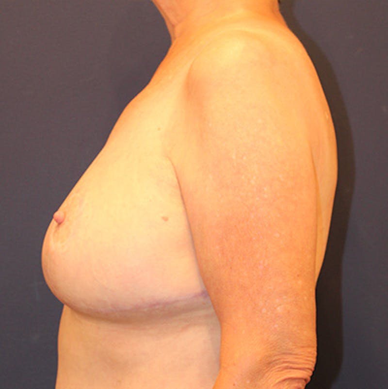 Breast Lift Before & After Gallery - Patient 198283783 - Image 6