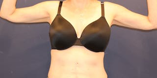 Emsculpt Neo Before & After Gallery - Patient 198283784 - Image 2