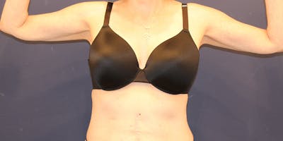 Emsculpt Neo Before & After Gallery - Patient 198283784 - Image 2