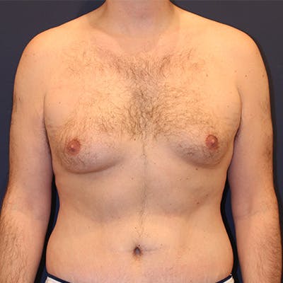 Male Breast Reduction/Gynecomastia Before & After Gallery - Patient 198283788 - Image 1