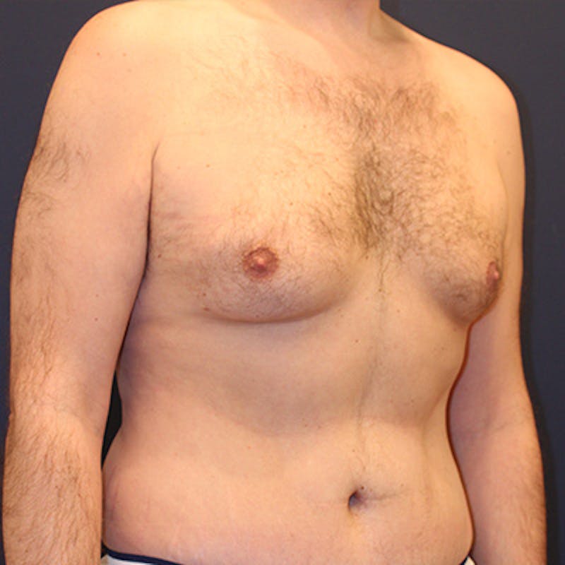 Male Breast Reduction/Gynecomastia Before & After Gallery - Patient 198283788 - Image 3