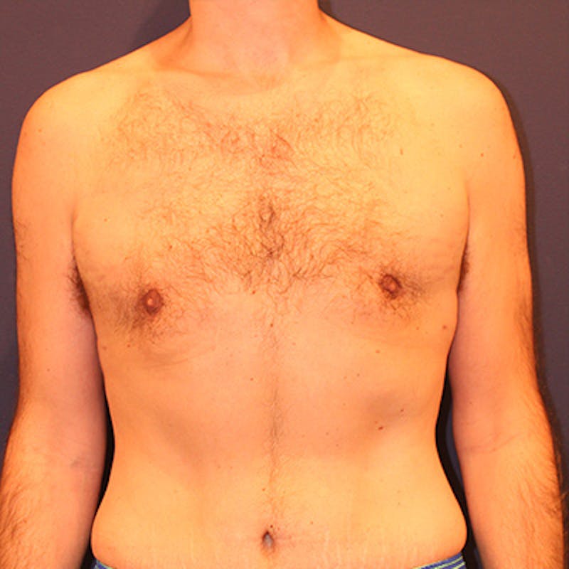 Male Breast Reduction/Gynecomastia Before & After Gallery - Patient 198283788 - Image 2