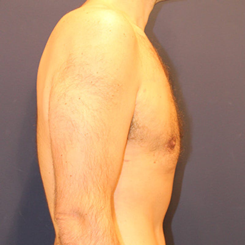 Male Breast Reduction/Gynecomastia Before & After Gallery - Patient 198283788 - Image 6
