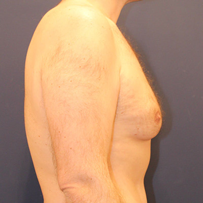 Male Breast Reduction/Gynecomastia Before & After Gallery - Patient 198283788 - Image 5