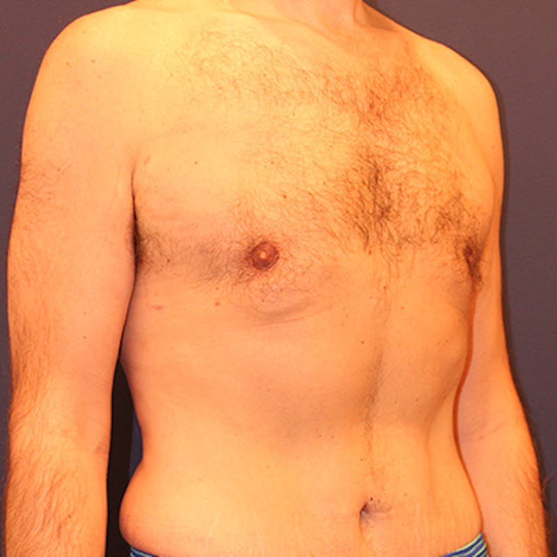 Male Breast Reduction/Gynecomastia Before & After Gallery - Patient 198283788 - Image 4