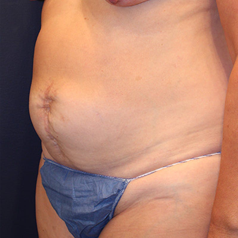 Tummy Tuck Before & After Gallery - Patient 198283789 - Image 3