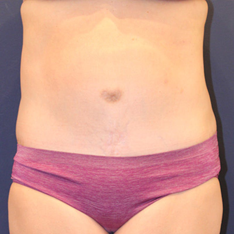 Tummy Tuck Before & After Gallery - Patient 198283789 - Image 2