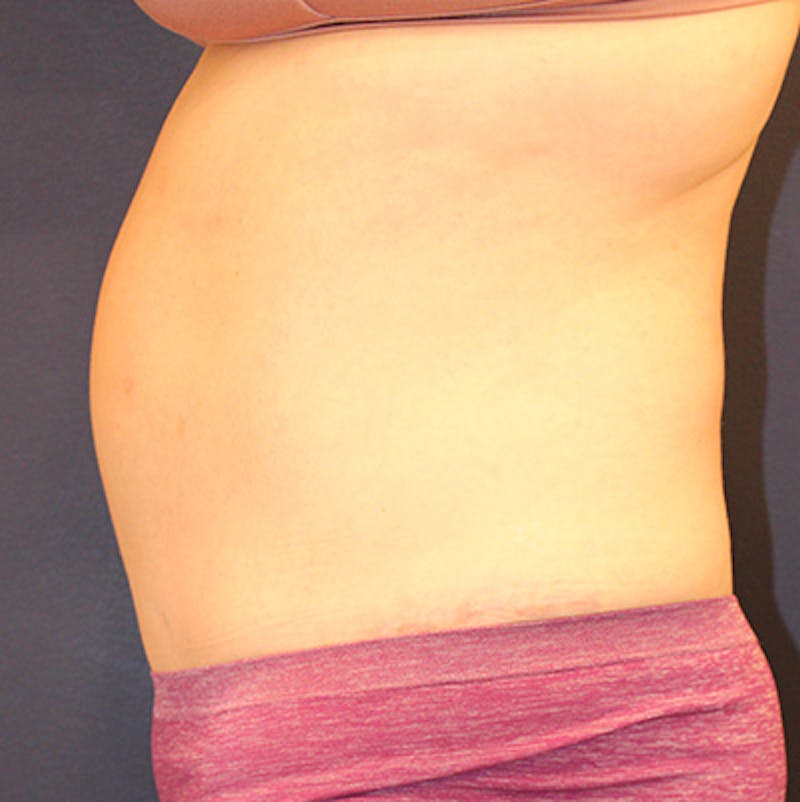 Tummy Tuck Before & After Gallery - Patient 198283789 - Image 6
