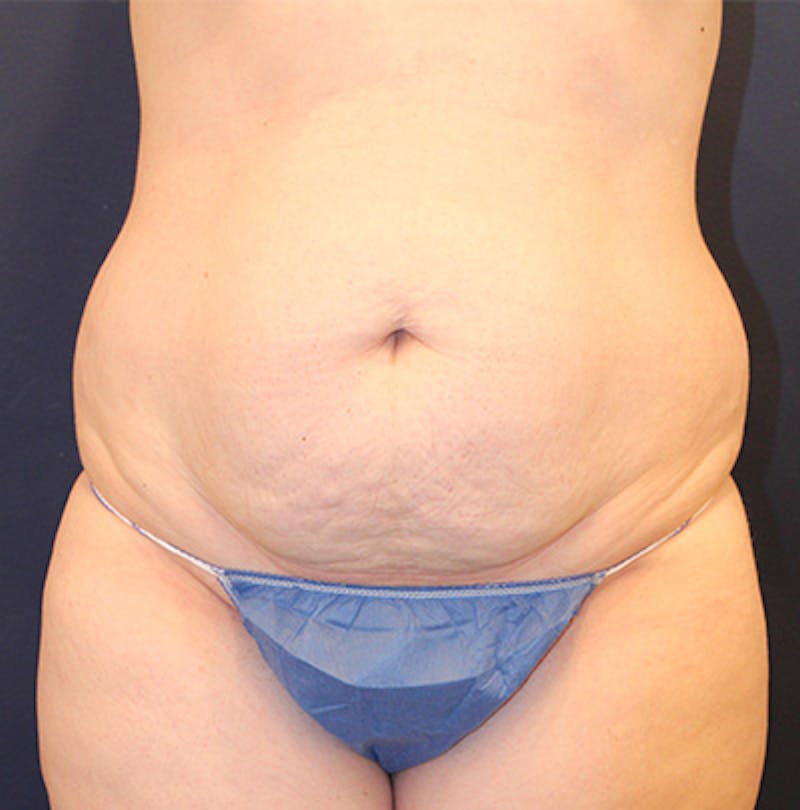 Tummy Tuck Before & After Gallery - Patient 199259232 - Image 1