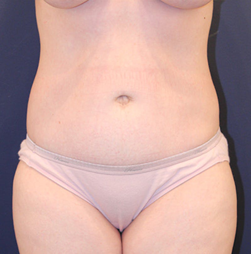 Tummy Tuck Before & After Gallery - Patient 199259232 - Image 2