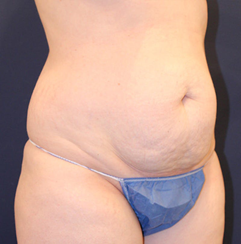 Tummy Tuck Before & After Gallery - Patient 199259232 - Image 3