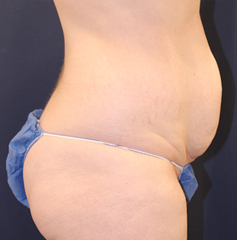 Tummy Tuck Before & After Gallery - Patient 199259232 - Image 5
