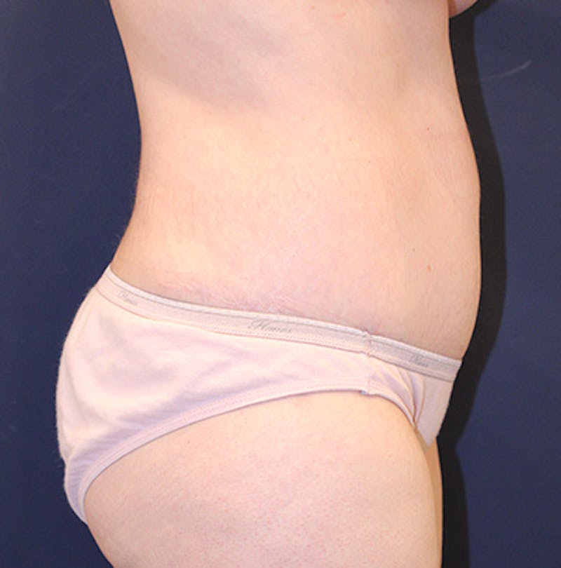 Tummy Tuck Before & After Gallery - Patient 199259232 - Image 6