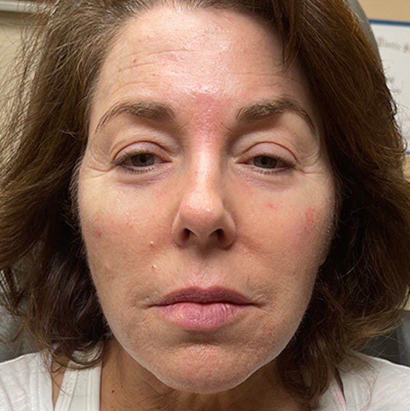 Injectables Before & After Gallery - Patient 200297524 - Image 1
