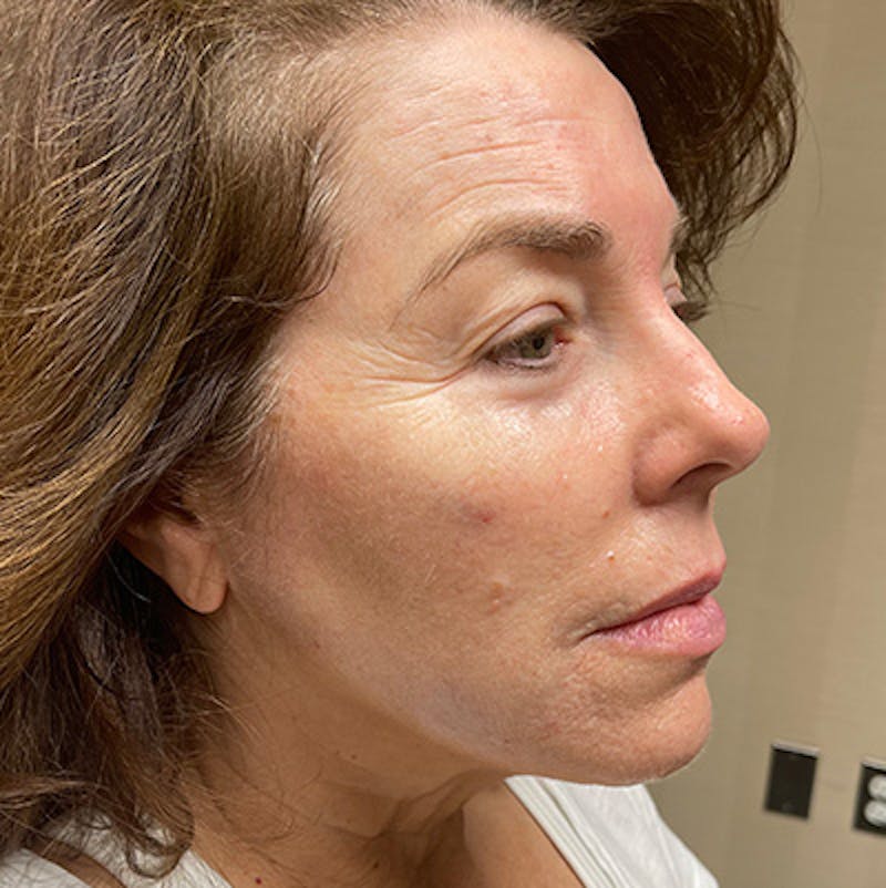 Injectables Before & After Gallery - Patient 200297524 - Image 3