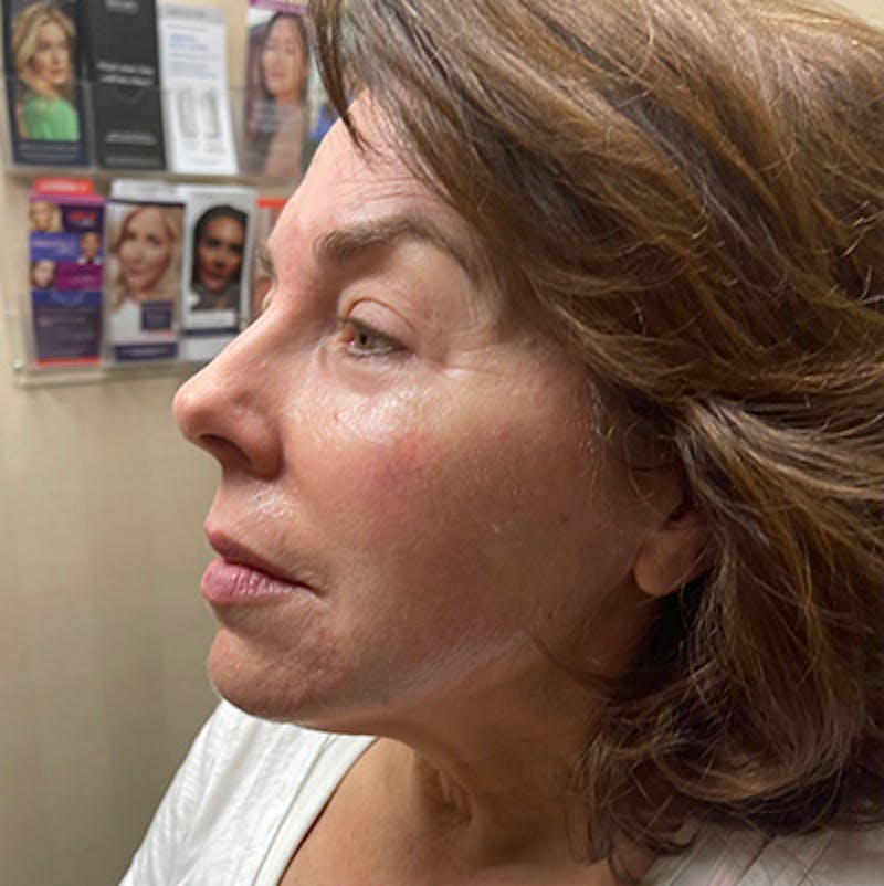 Injectables Before & After Gallery - Patient 200297524 - Image 5