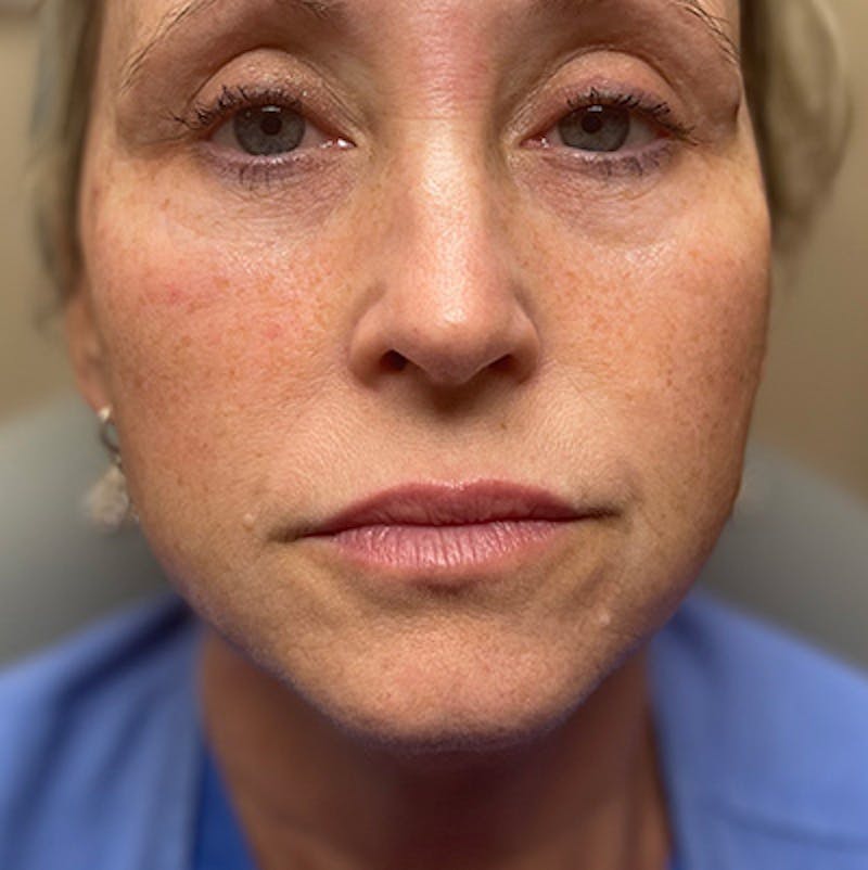 Injectables Before & After Gallery - Patient 200297632 - Image 1