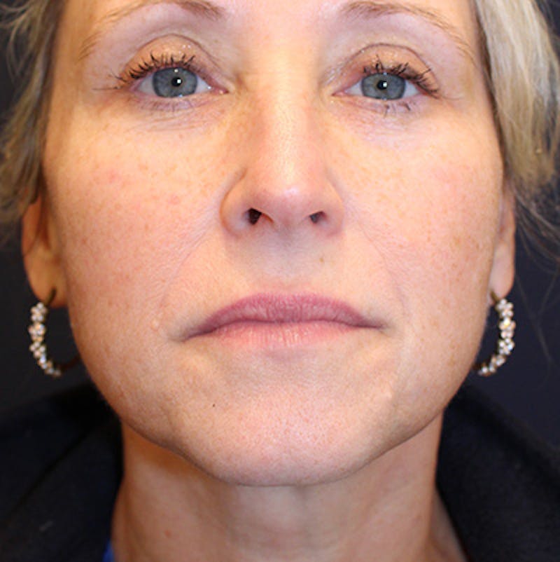 Injectables Before & After Gallery - Patient 200297632 - Image 2